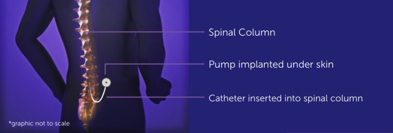 Graphic of a person's spinal column with a medicinal pump implanted into stomach and catheter delivering medicine to spine